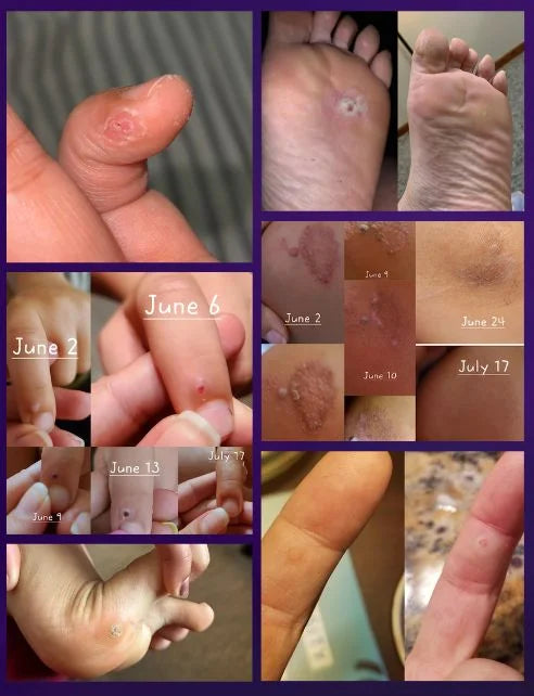 Luminiix Remedio Natural para Verrugas