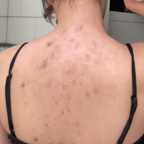 Back Acne® Spray Milagroso para Espalda